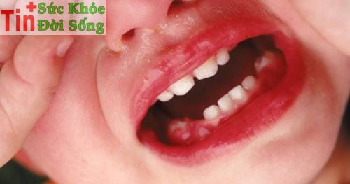Cách trị viêm lợi chảy máu chân răng sưng đau nướu răng hàm tại nhà