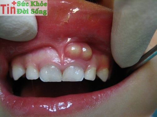 Cách trị viêm lợi sâu răng sưng đau nướu răng hàm tại nhà