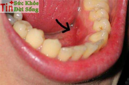 Cách chữa viêm nướu răng sưng nướu răng viêm lợi sâu răng có mủ tại nhà