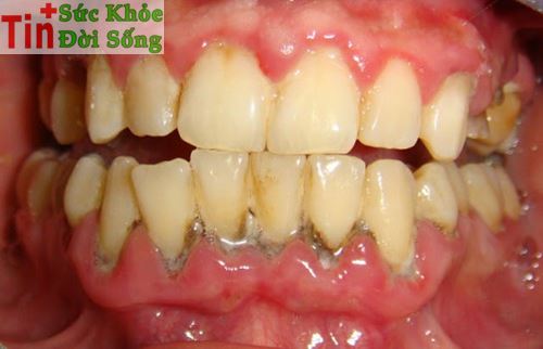 Nướu răng bị sưng đỏ chảy máu viêm lợi viêm chân răng nên dùng thuốc gì tốt nhất