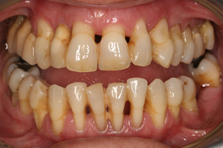 Nướu răng bị sưng đỏ chảy máu viêm lợi tụt lợi nên dùng thuốc gì tốt nhất