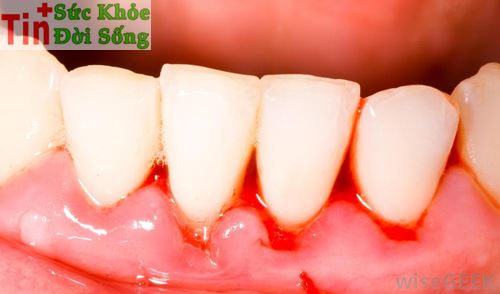 Những sai lầm nên tránh khi chữa viêm lợi sưng nướu răng 4
