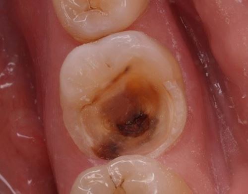 điều trị sâu răng viêm tủy răng