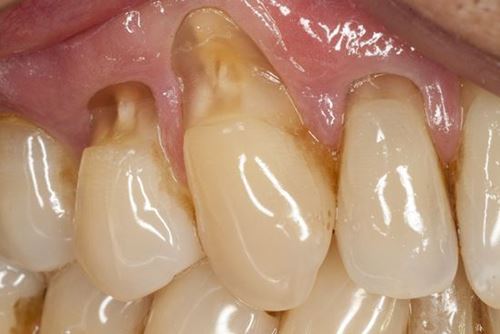 cách trị nhức răng viêm nha chu