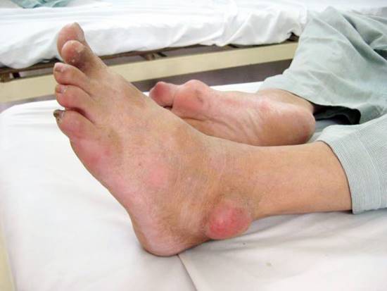 cách trị đau khớp gối