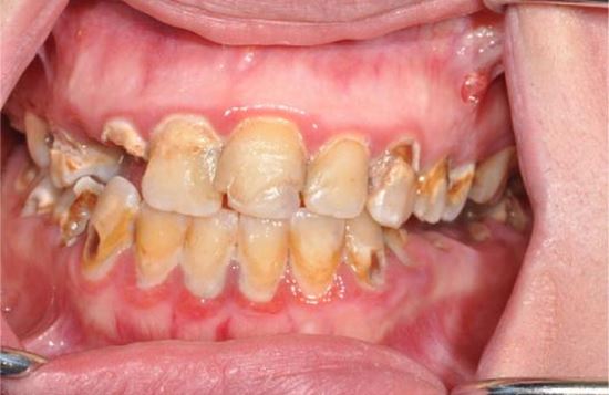 cách trị đau răng sâu viêm chân răng tại nhà