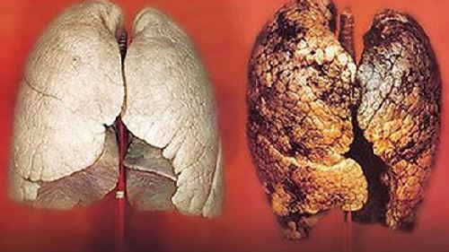 bệnh ung thư phổi
