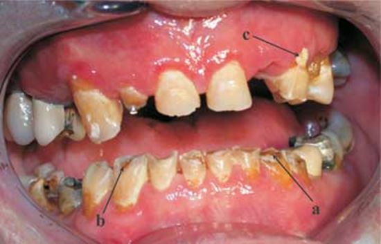 trị nhức răng nhanh sâu răng chảy máu chân răng khỏi hoàn toàn